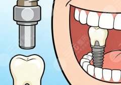 蘇州吳中區(qū)華爾康口腔種植牙怎么樣？多少錢(qián)？不同方案的報(bào)價(jià)明細(xì)幫你列好了