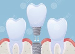 衢州藍(lán)芽口腔診所種植牙怎么樣？多少錢(qián)？真實(shí)種牙口碑實(shí)測(cè)，收費(fèi)區(qū)間一次摸清