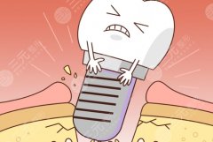 上海美信口腔種植牙怎么樣？多少錢(qián)？項(xiàng)目反饋和價(jià)格參考，這篇給你盤(pán)明白