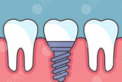 沈陽歡樂仁愛口腔醫(yī)院種植牙怎么樣？多少錢？醫(yī)院口碑和種牙費用一文匯總