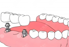 樂山醫(yī)大口腔種植牙怎么樣？多少錢？技術優(yōu)勢和價格參考整理好了
