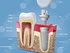 昆明美奧口腔種植牙怎么樣？多少錢？種植體驗和價格參考一起整理