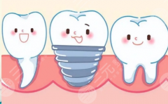 茂名致美口腔種植牙怎么樣？多少錢？帶你看清一顆牙背后的費用構成