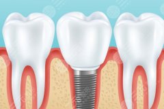 長沙好大夫口腔醫(yī)院種植牙怎么樣？多少錢？醫(yī)院種牙情況和費用整理好了