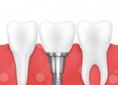 烏魯木齊福宏林口腔種植牙怎么樣？多少錢？種植表現(xiàn)和收費區(qū)間同步整理