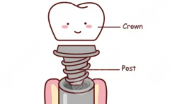 江門市港灣僑邑口腔種植牙怎么樣？多少錢？從缺牙修復需求出發(fā)，看它家種牙到底有何亮點