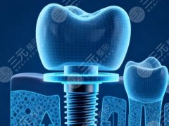 武漢晴川立康口腔種植牙怎么樣？多少錢？種牙體驗和價格區(qū)間整理好了