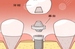 保定精卓口腔種植牙怎么樣？多少錢？醫(yī)生團(tuán)隊、設(shè)備配置、收費透明度全方位拆解