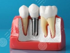 珠海九龍簡(jiǎn)牙口腔種植牙怎么樣？多少錢(qián)？新價(jià)格明細(xì)一一揭曉