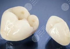 哈爾濱慧愛口腔種植牙怎么樣？多少錢？冰城缺牙人必看的種牙全攻略