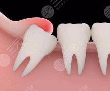 蕪湖皓芽口腔種植牙怎么樣？多少錢？看完這篇就知道怎么種牙了