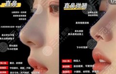 長(zhǎng)治人民醫(yī)院隆鼻價(jià)格貴不貴？2026全新價(jià)目表一覽