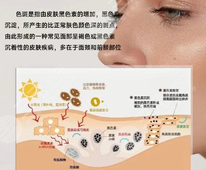 祛斑
