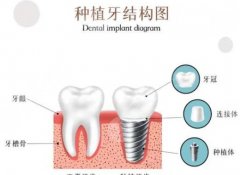 衢州中醫(yī)院牙齒種植費(fèi)用貴不貴？明細(xì)展示_種牙低至1w9左右