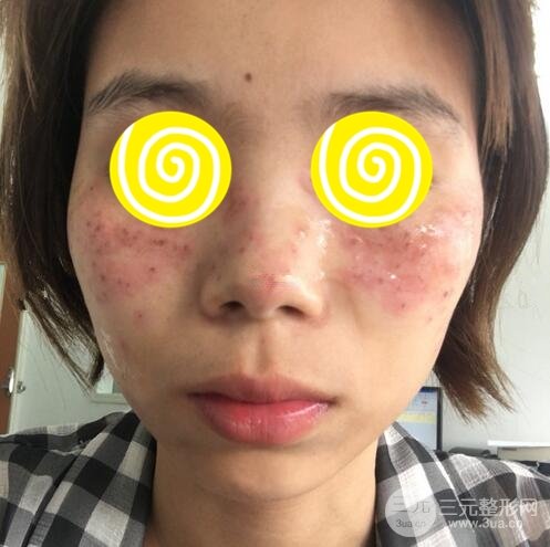 激光祛斑三天后的照片和幾天結(jié)痂脫落過(guò)程案例