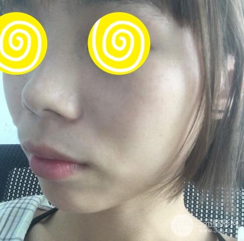 激光祛斑三天后的照片和幾天結(jié)痂脫落過(guò)程案例