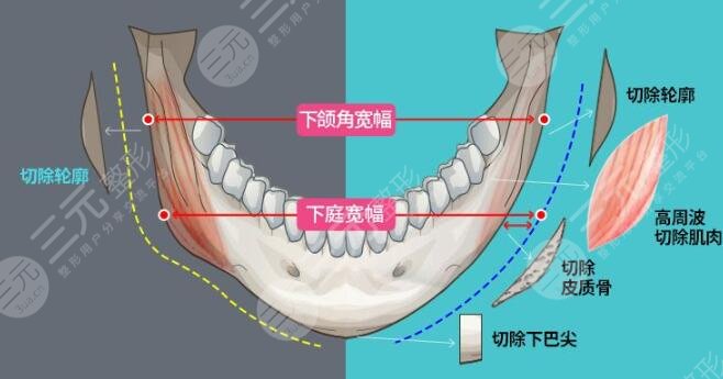 下頜角切除費(fèi)用一般多少錢？下頜角切除手術(shù)優(yōu)勢是什么？