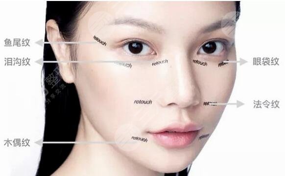 臉部皺紋的種類(lèi)有哪些？歐洲之星？熱拉提？B****？總有一項(xiàng)適合你！