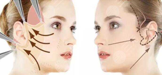 小切口除皺保持幾年？小切口除皺的危害及維持時間是多久？走進科普