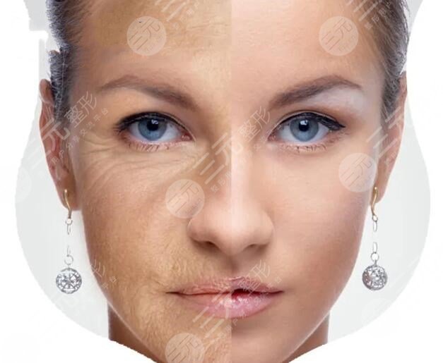 拉皮除皺手術(shù)能保持多少年？拉皮除皺手術(shù)維持時間及收費價格怎么算？