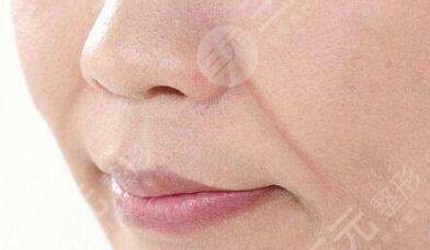 拉皮手術(shù)可以去除法令紋嗎？去除法令紋有的方法是什么？