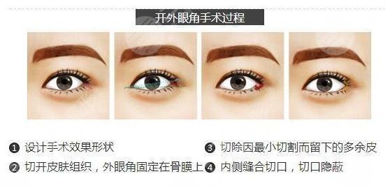 重慶哪家醫(yī)院開(kāi)眼角Z專(zhuān)業(yè)