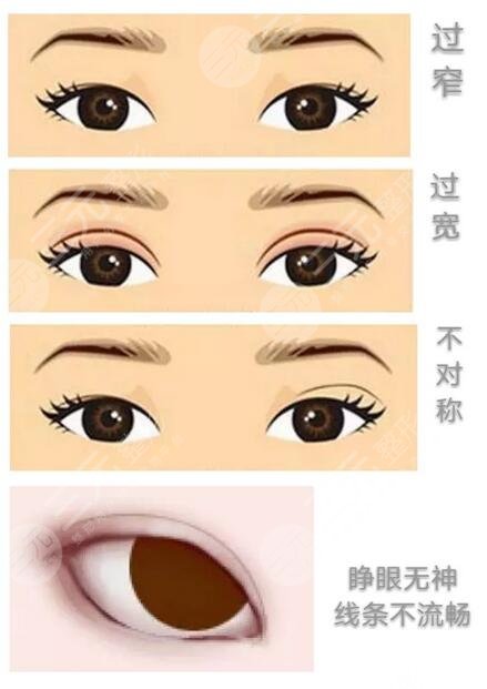 成都割雙眼皮有危險(xiǎn)嗎