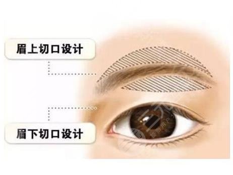 提眉術(shù)疼不疼