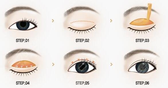 老年人還能眼部整形嗎?需謹(jǐn)慎!