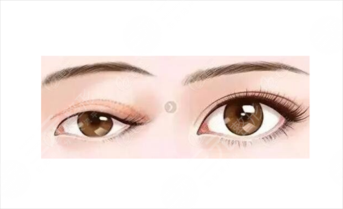 在深圳做眉整形手術(shù)需要多少錢？