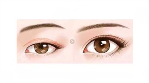 眼窩填充術前后照片參考，凹陷的眼窩可不是深邃哦！