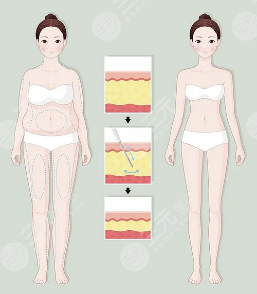 減肥瘦身激光溶脂果好不好?術(shù)后護(hù)理如何做?