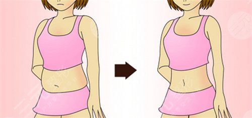 激光溶脂減肥塑形果會(huì)持續(xù)多久?