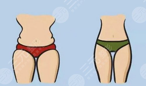 臀部共振吸脂果怎么樣？?jī)r(jià)格貴嗎？要注意哪些？