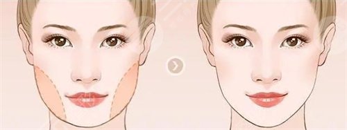 光纖溶脂瘦臉的危害有哪些？