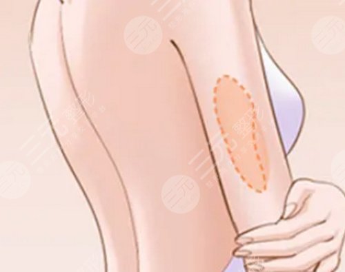 什么是抽脂術(shù)?抽脂手術(shù)可能帶來哪些風(fēng)險(xiǎn)?