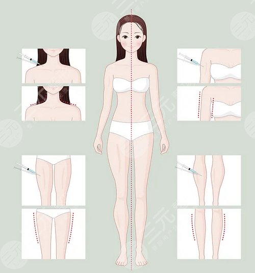 火鳳凰溶脂和冷凍哪個好？優(yōu)缺點對比+注意事項，術前必看！