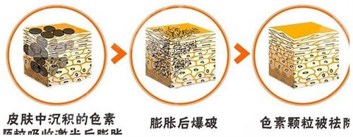 長老年斑是什么原因、怎樣去除手上的老年斑