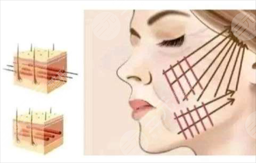 光子嫩膚的優(yōu)點(diǎn)那里好？怎么選擇？